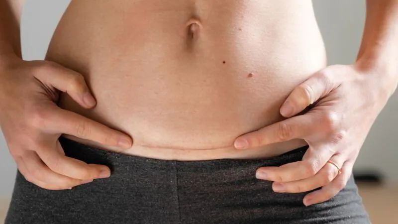 Pelvic physiotherapy post cesarean birth