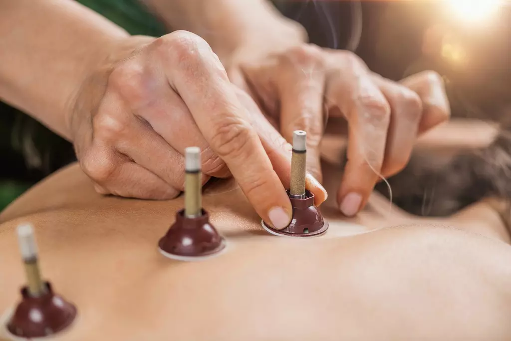 Breech Presentation Solution: Acupuncture and Moxibustion