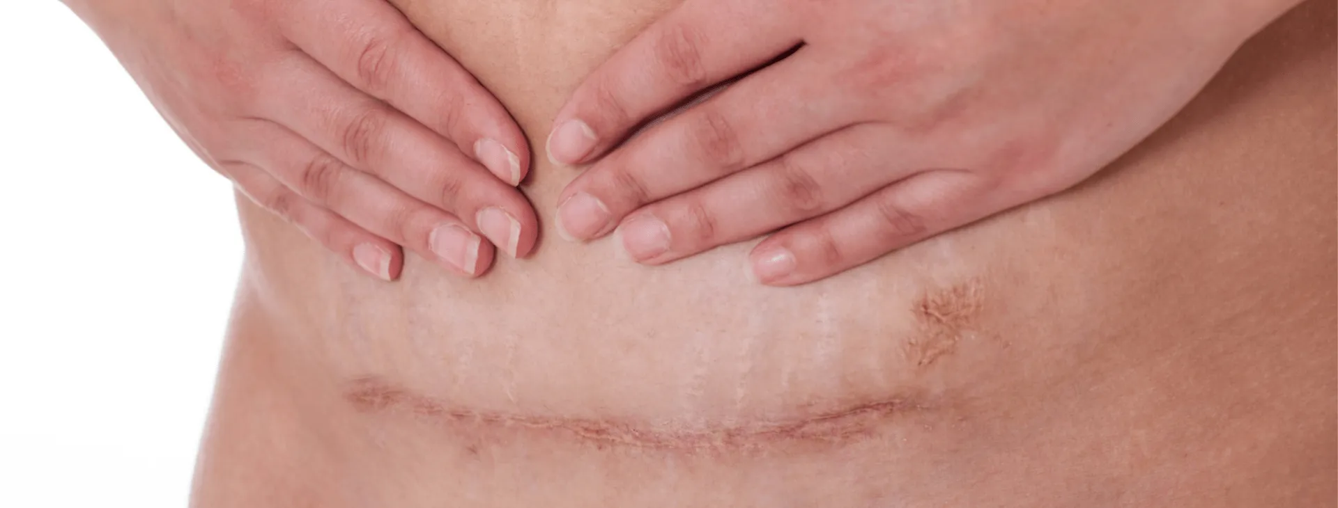 Guest blog: caesarian birth recovery and the importance of self-massage